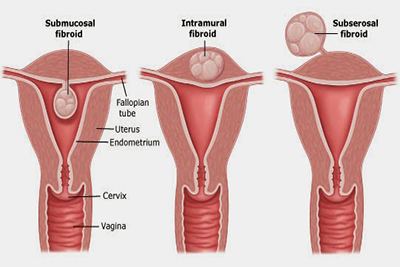 Fibroid-anatomy