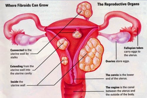 Fibroids And Infertility | Nordica