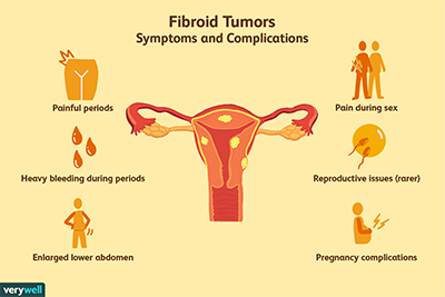 fibroid symptoms2