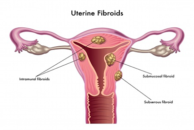 uterine fibroids