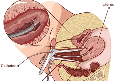 Endometrial Scratching