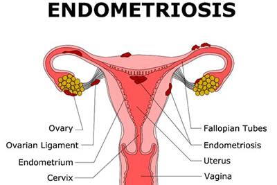 endometriosis-