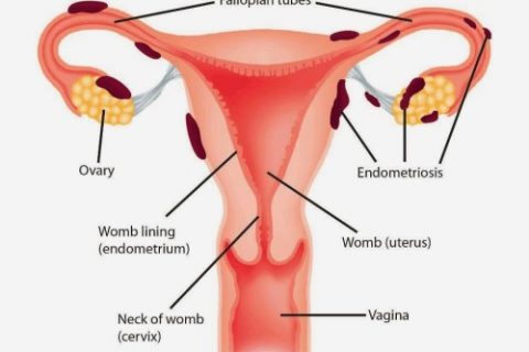endometriosis-e1438782229274