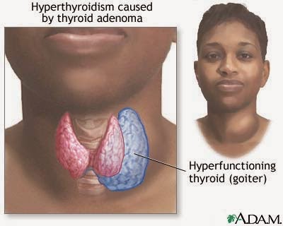 hyperthyroidism