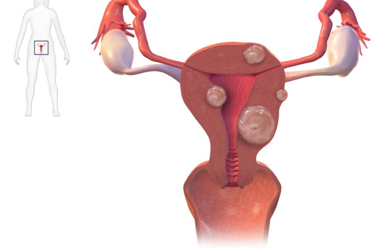 Uterine_Fibroids commoms.wikimedia